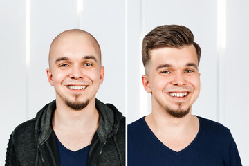 Man before and after transplant hair and alopecia - obrazy, fototapety, plakaty