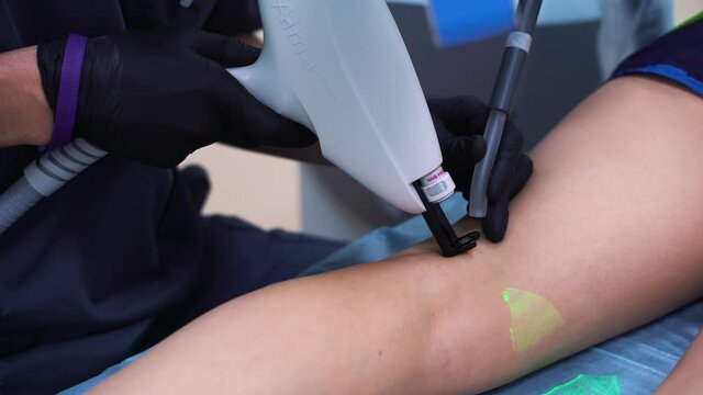 A doctor does medical procedure Sclerotherapy used to eliminate varicose veins and spider veins. An injection of a solution directly into the vein.