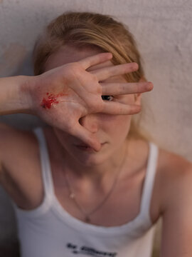 Young female showing scratched hand