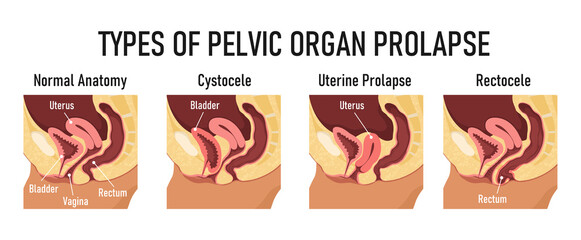 Types of pelvic organ prolapse - cystocele, uterine prolapse, rectocele