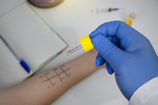 An allergist doctor in the laboratory conducts a prik allergy test. Skin test for household, food, epidermal allergic reactions