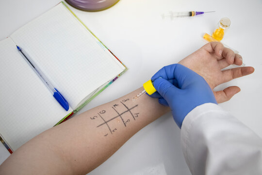 An Allergist Doctor In The Laboratory Conducts A Prik Allergy Test. Skin Test For Household, Food, Epidermal Allergic Reactions