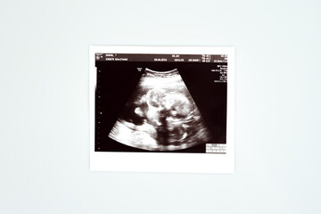 Result of ultrasound picture or ultrasonography for pregnancy on top of white isolated background