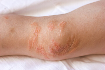 Manifestation of atopic dermatitis on the child’s body, rash redness and dry knees an allergic...