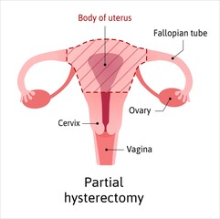 Hysterectomy, surgical removal of the uterus. Medical vector illustration shows one type of hysterectomy partial, when removes only body of uterus
