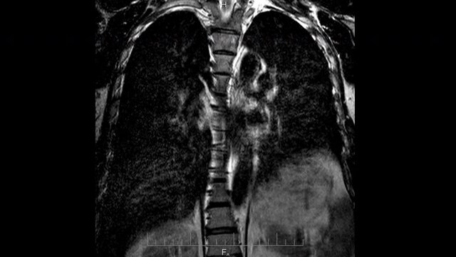 MRI spine and lung scan, magnetic resonance imaging of a back and skeleton close-up, time lapse