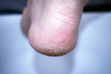 Dry skin on the feet