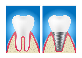 Dental implant structure medical / tooth and teeth concept vector on white