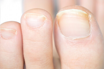 Toenails on a woman's feet