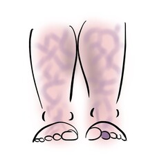 Livedo reticularis and blue finger