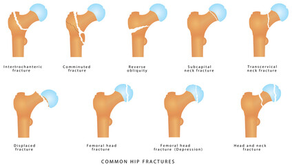 Hip fractures. Fractures of the proximal femur. Types of femoral neck fracture. Garden classification of hip fractures. Femoral neck fractures medical illustration on white background