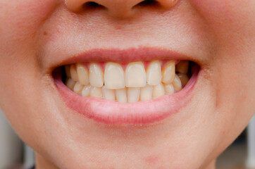close up of a woman mouth and teeth