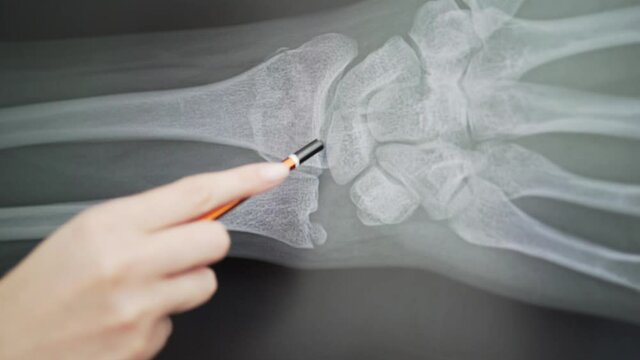 X-ray of a broken arm. The doctor at the hospital points to the fracture scene, close-up