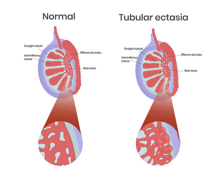 Tubular ectasia of rete testis with normal testicular anatomy