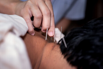 Acupuncture  massage