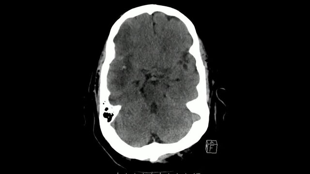 Computed Tomography Scan Of The Brain Axial Cuts Showing Massive Right Middle Cerebral Artery Infarction