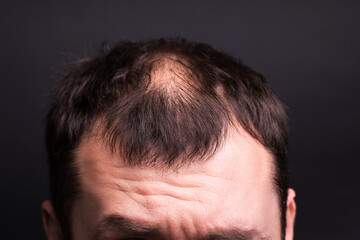 Obraz premium Male head close-up with baldness. Studio black background.