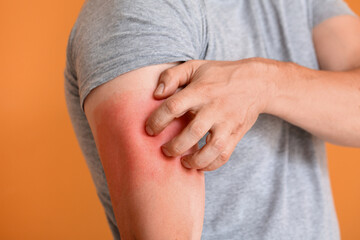 Man with red sunburned skin against color background, closeup