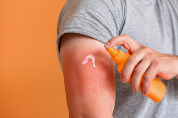 Man with red sunburned skin applying cream against color background, closeup