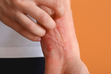 Woman with red sunburned skin against color background, closeup