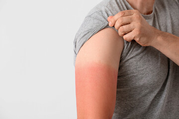 Man with red sunburned skin against light background, closeup