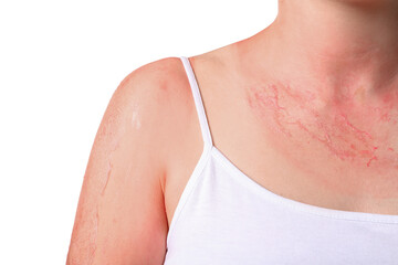 Woman with red sunburned skin against white background, closeup