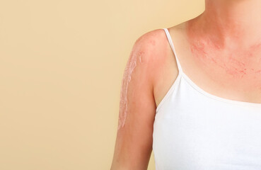 Woman with red sunburned skin against color background, closeup