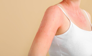 Woman with red sunburned skin against color background, closeup
