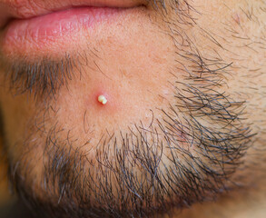 pimple
