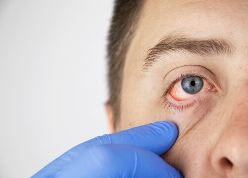 Close up of two annoyed red blood eyes of male affected by conjunctivitis or after flu, cold, allergy. Copy space for advertisement. Tired eyes after working at the computer. Close-up and macro