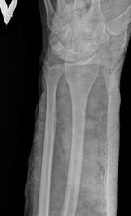 The fracture of the radial and ulnar bone with displacement - X-ray. Human's Broken Hand