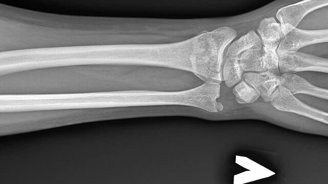 X-rays of a broken arm. Human Anatomy, image of a bone injury with displacement