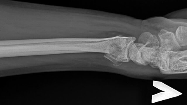 An X-ray of a fractured human bone in motion. Skeleton Anatomy