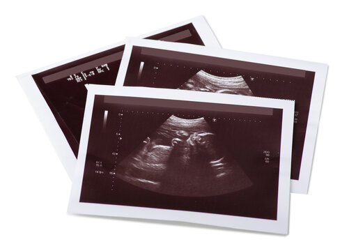 ultrasound film baby on white background isolation