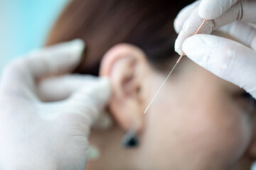 The doctor's hand in glove with needle for acupuncture
