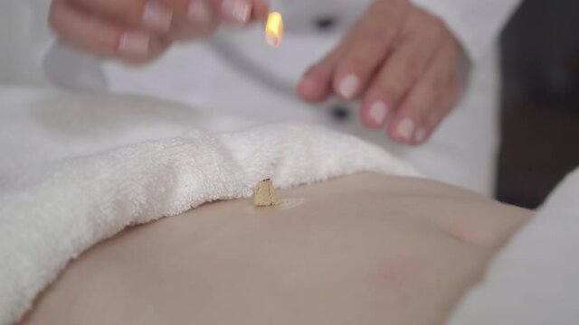 Doctor lighting up moxa on female belly. Professional Caucasian acupuncturist healing stomachache or gynecological problems of unrecognizable young woman. Direct moxibustion, acupuncture.