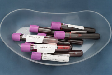 Blood in Collection Tubes for Medical Research