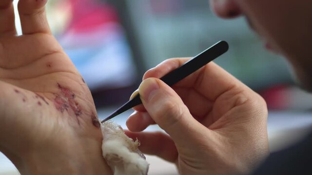 Man cleaning a bleeding wound under the skin after the accident.Traumatic pain of a hand. Treatment and disinfection of deep wounds.