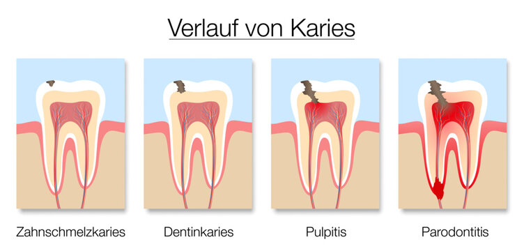 Caries stages infographic, german labeling, development of tooth decay with enamel and dentin caries, pulpitis and periodontitis. Vector illustration on white.

