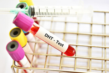 Test tube with blood sample for dihydrotestosterone or DHT hormone test