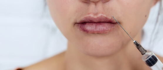 Plastic lips. Women's lips after injections of hyaluronic acid. Complications after lip...