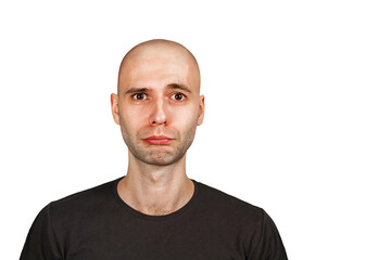 Confused young bald man with alopecia. guy skin head with hair loss want transplant, isolated on white background
