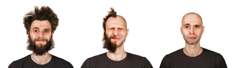 set bald and shaggy man before and after transplant hair and alopecia or haircut. Isolated on white background