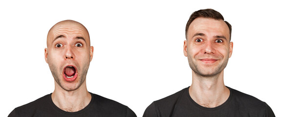 bald man before and after transplant hair and alopecia. Isolated on white background