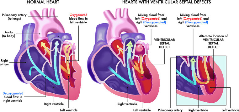 Medical illustration that compares a normal heart with hearts afflicted by ventricular septal defects, an abnormal opening (hole) in the heart, with annotations.