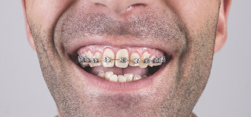 Closeup. Caucasian man with a braces on teeth.