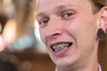 Portrait of a twenty five year old guy with braces on his teeth, smiling. Wrong bite in a young smiling guy. Dental pathology, correction of malocclusion in young people