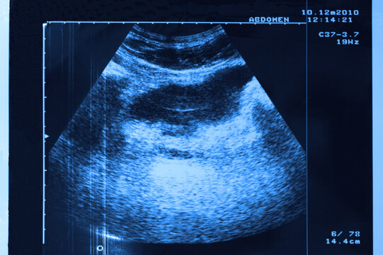 photo of ultrasound of stomach in blue tone