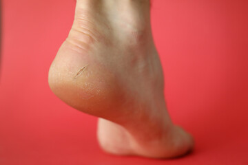 Close-up of badly cracked heel. Persons feet with dry skin. Barefoot adult with unattractive and unhealthy foot. Salon treatment and skin procedure needed concept