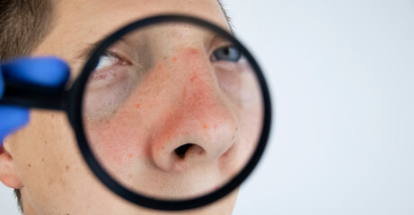 Acne close-up. A man is being examined by a doctor. Dermatologist examines the skin through a...